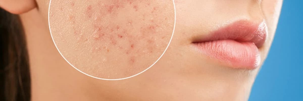 Dəri infeksiyaları