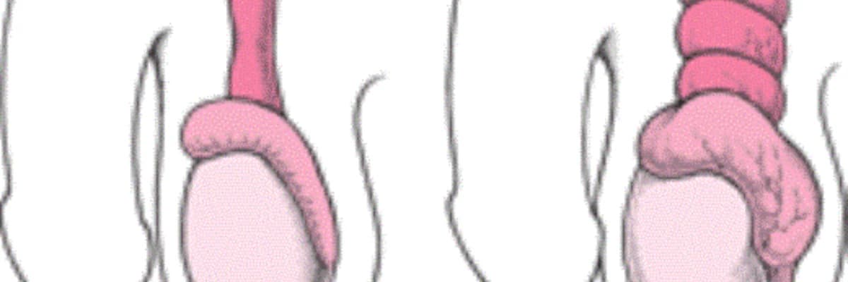 Testis Torsiyası: Ani və Təcili Bir Tibbi Vəziyyət