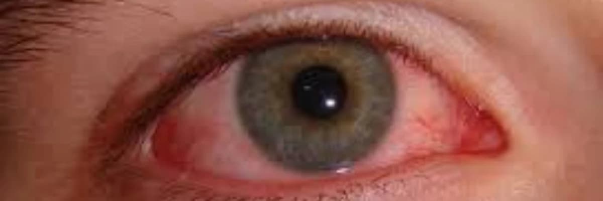 İnfeksiyalara Yoluxma Nəticəsində Gözlərdə Müxtəlif Xəstəliklər Yarana Bilər