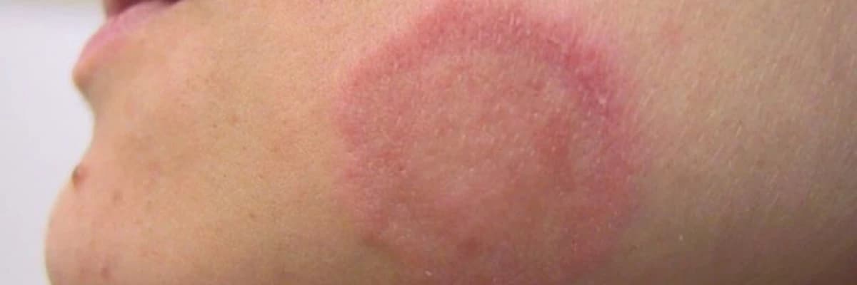 Dəri infeksiyaları (göbələk xəstəlikləri, ziyillər, çibanlar)