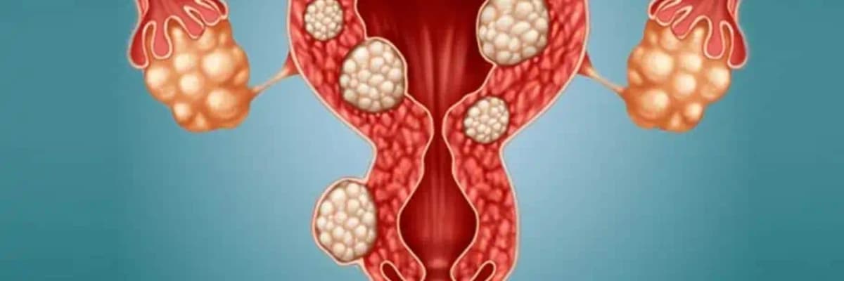 Yumurtalıq kistaları: diaqnoz, müalicə və qarşısının alınması