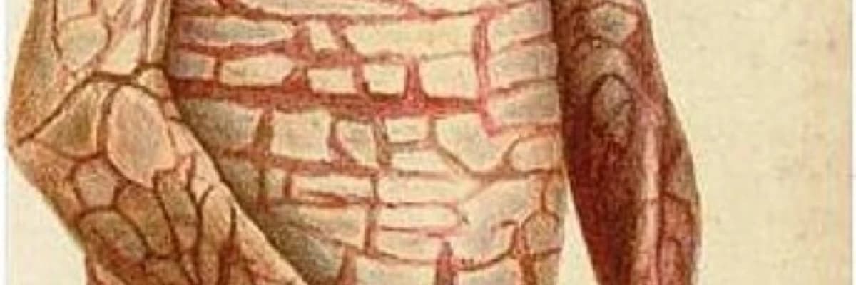 Harlequin Tipli İktiyozis : Nadir Dəri Vəziyyətini Anlamaq