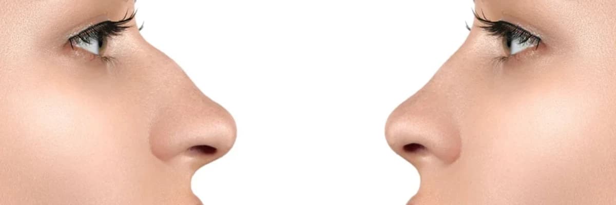 Burun Əməliyyatı Sonrası Eynək İstifadəsi