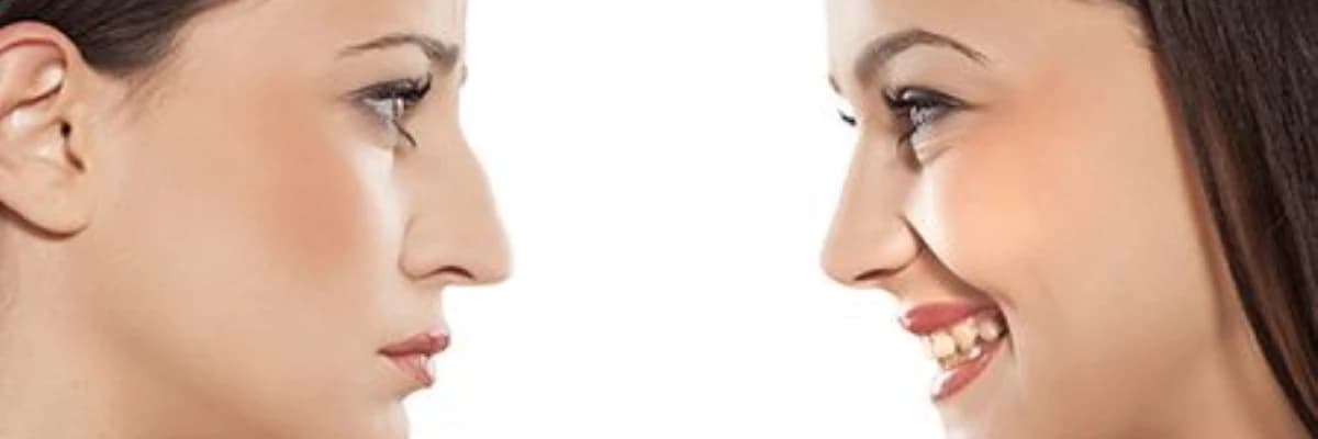Rinoplastika nədir və necə tətbiq olunur?