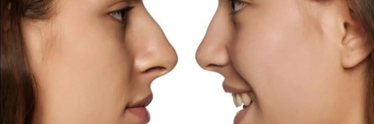 Rinoplastika - Burun Estetik Cərrahiyyəsi