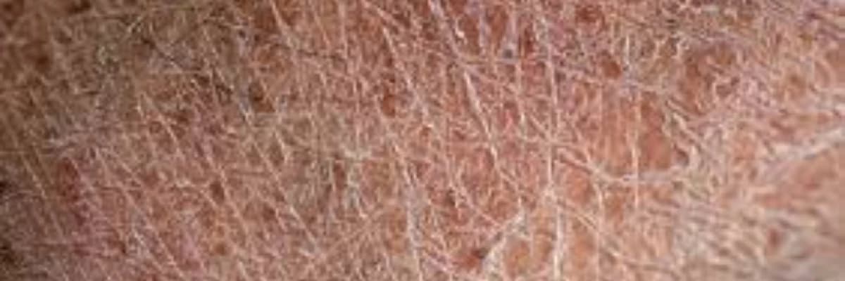 Dəri quruluğu (Xerosis cutis)