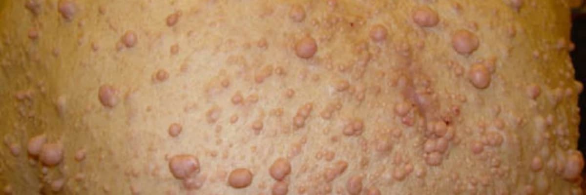 Neyrofibromatoz Tip I: Genetikası, Diaqnozu və Müalicə Yolları