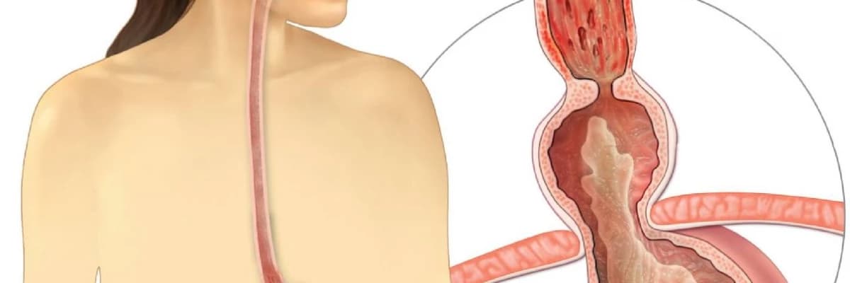 Mədə yırtığı (hiatal yırtıq)