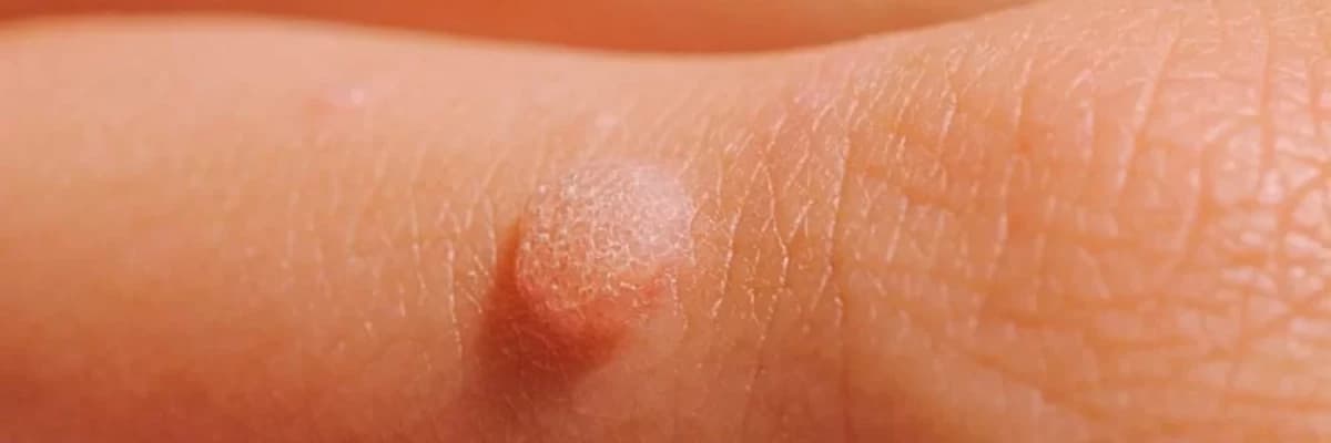 Əl-ayaq ziyillərinin ləğvi