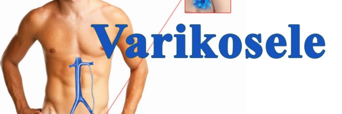 Varikosele haqqında