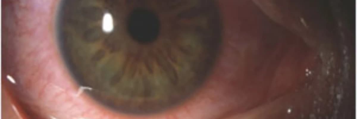 Allergik rinokonyuktivit