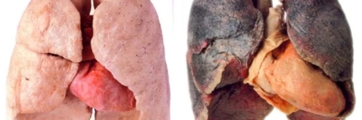 Ağciyərlərin xroniki obstruktiv xəstəliyi