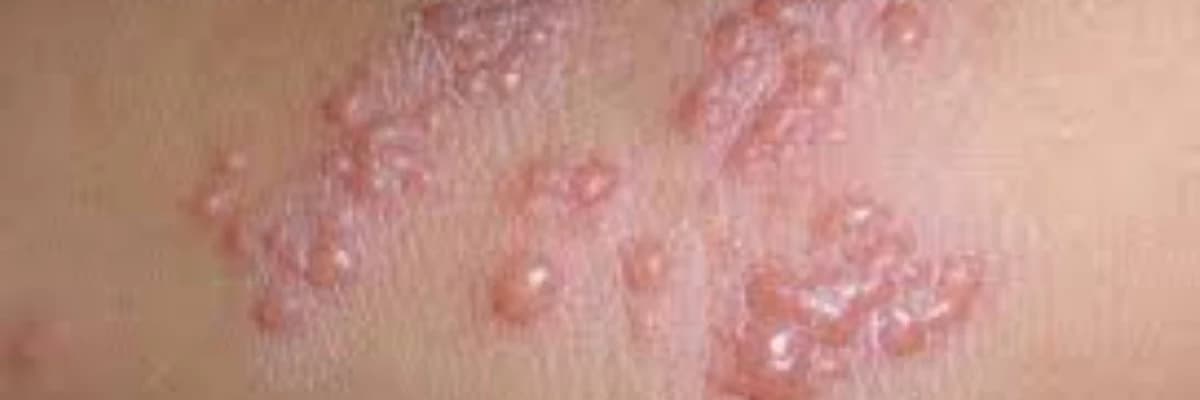 Herpes Zoster (Kəmərləyici Dəmrov)