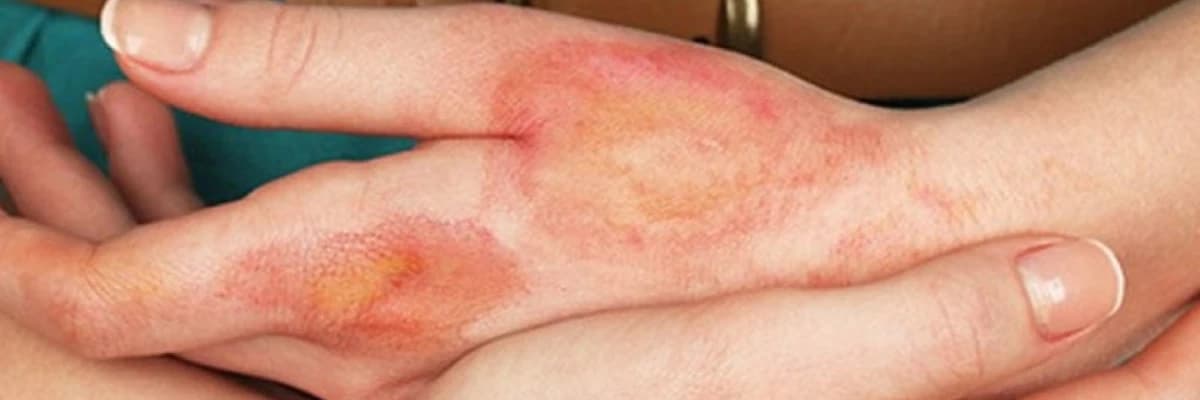 Açıq yaralar haqqında