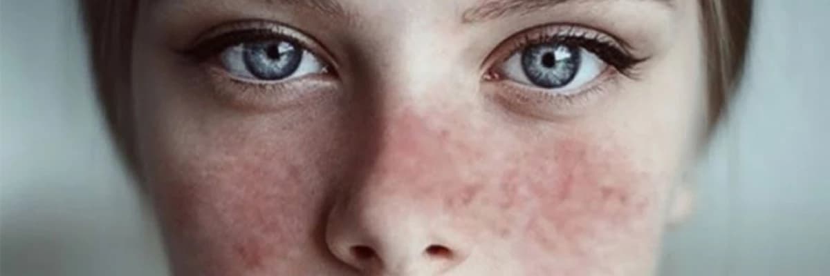 Sistem qırmızı qurdeşənəyi (lupus)