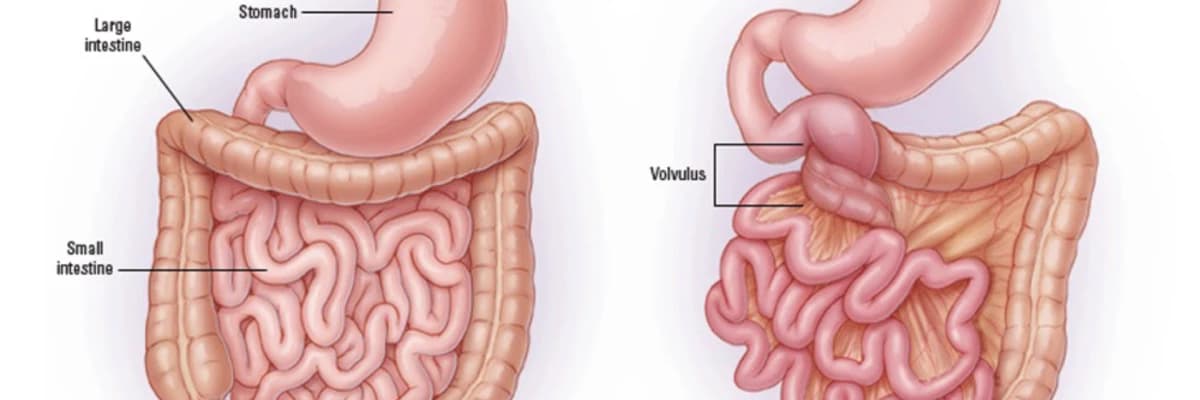 Onikibarmaq bağırsaq və digər bağırsaq hissələrinin atreziyası