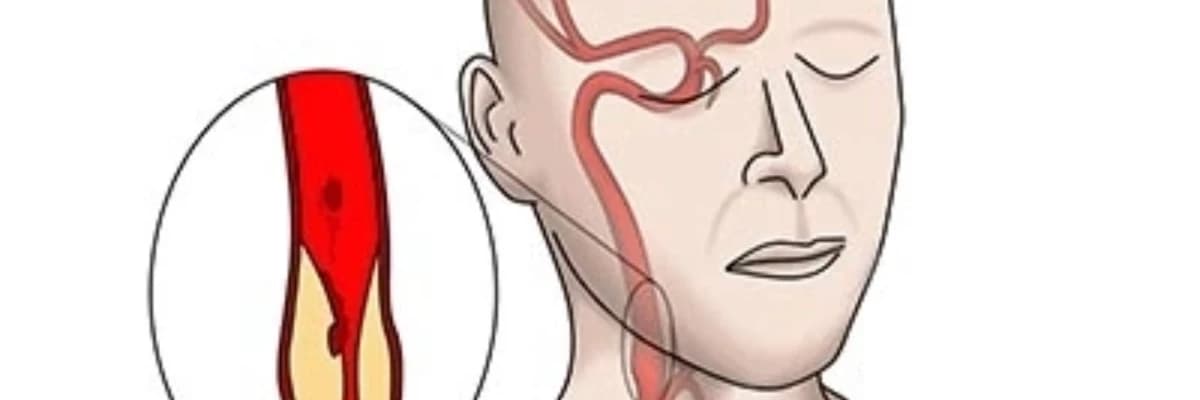 Karotis Stent: Karotis Arteriyalarının Açılması və Xəstəliklərin Müalicəsi