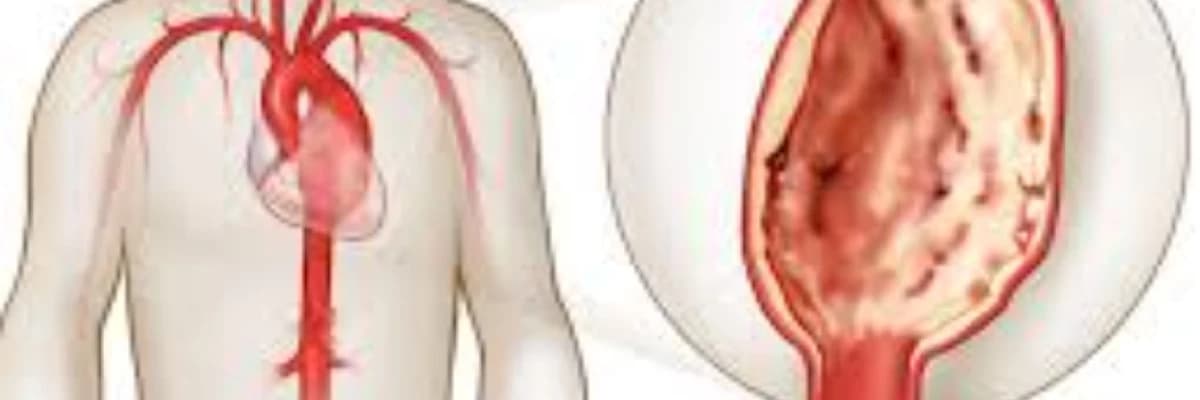 Arterial və venoz anevrizmalar