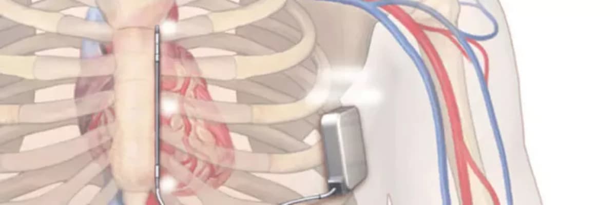 Kardiostimulyator İmplantasiyası: Ürək Ritmini Bərpa Etmə Yolu