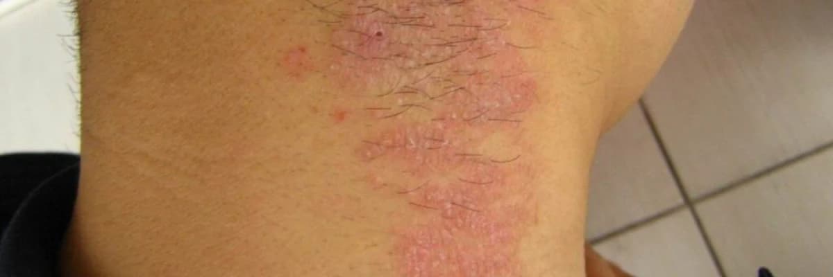 Neyrodermit xroniki bir dəri xəstəliyi