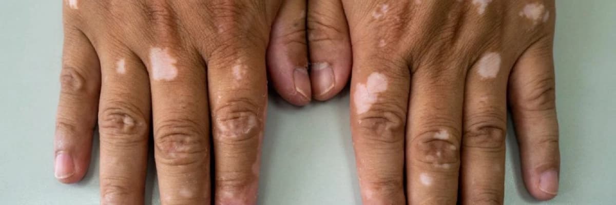 Vitiligo Xəstəliyi: Səbəbləri, Simptomları və Müalicə Yolları