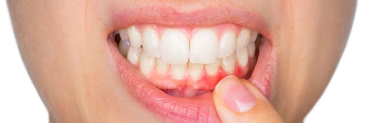 Diş əti iltihabı: müalicə, səbəblər və profilaktik tədbirlər