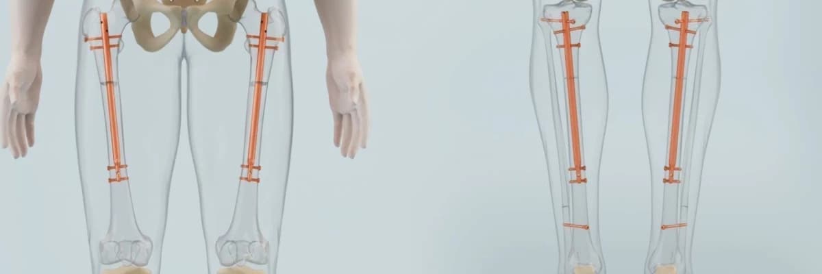 Uşaqlarda və Yetkinlərdə Boy Uzatma Cərrahiyyəsi