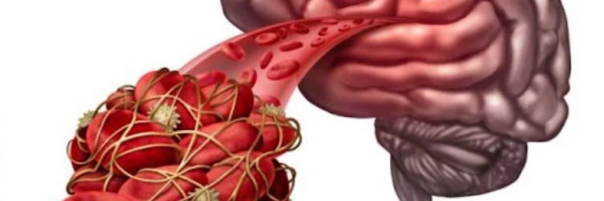 Arteriovenoz Malformasiya (AVM): Tərif, Səbəbləri və Müalicə Yolları