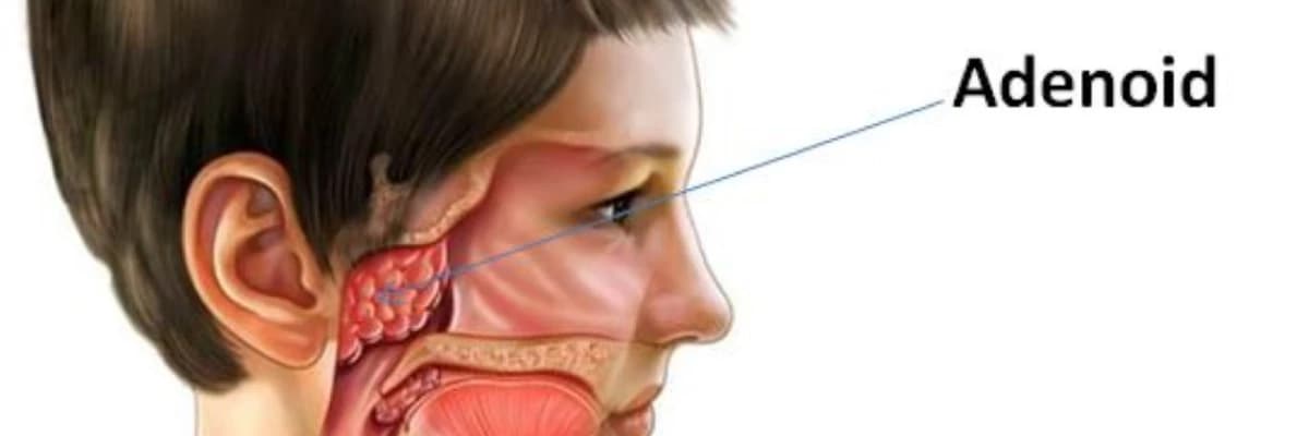 Adenoidlər