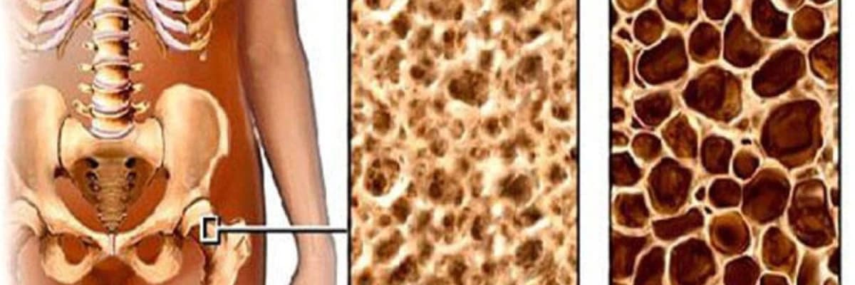 Osteoporoz xesteliyi