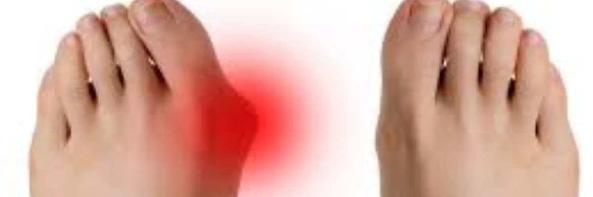 Hallux valgus ağrısı