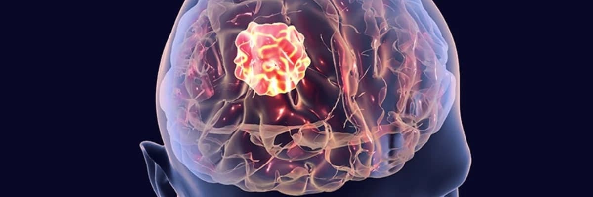 Beyin şişləri haqqında hər şey