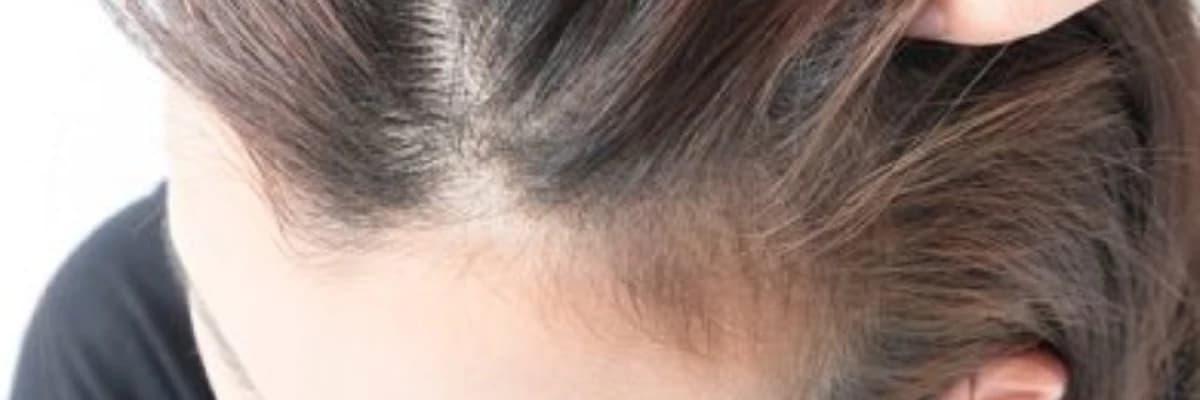 saç xəstəlikləri