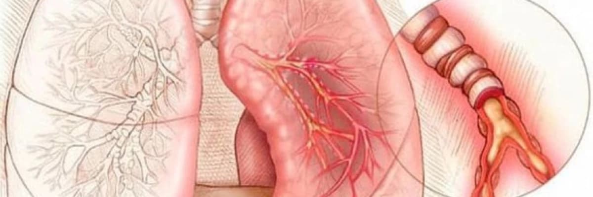 Ağciyərin bül səbəbindən pnevmotoraksı