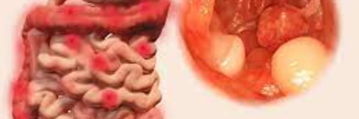 Düz bağırsaq polipləri