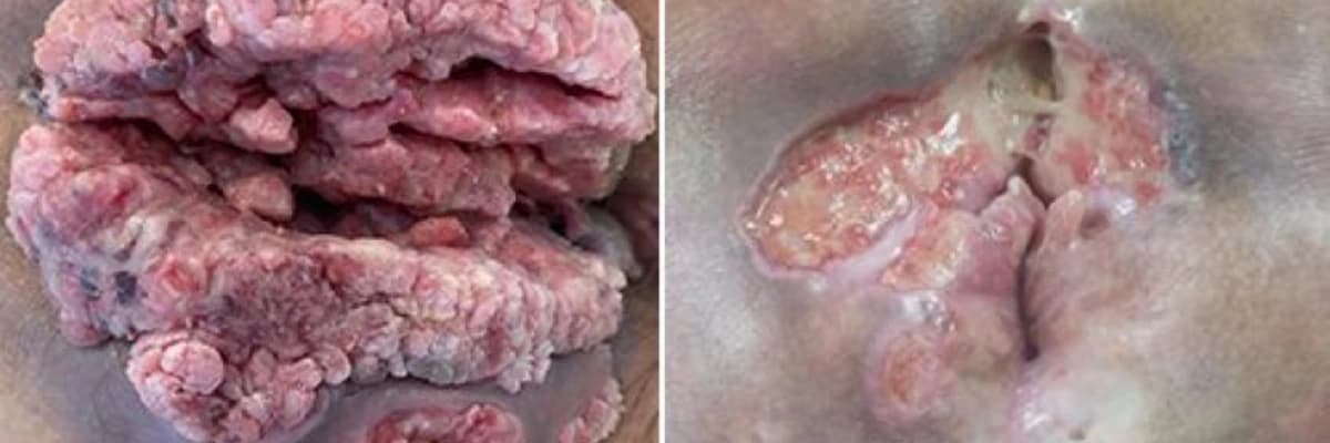 Buske lyovensteyn kondilomasi