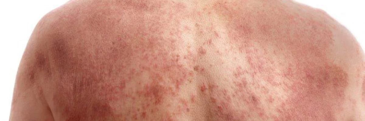 Xolinergik Ürtiker: Stress və İstilərə Reaksiya Olaraq Dəri Ürtikeri