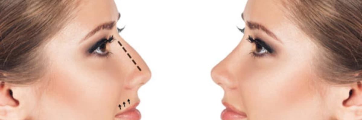 Septoplastika əməliyyatı