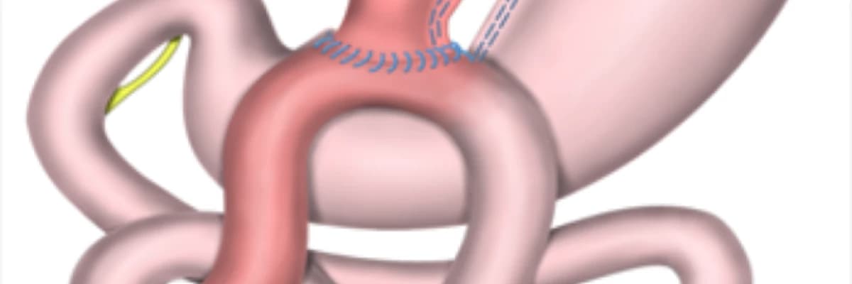 Mini Qastrik Bypass