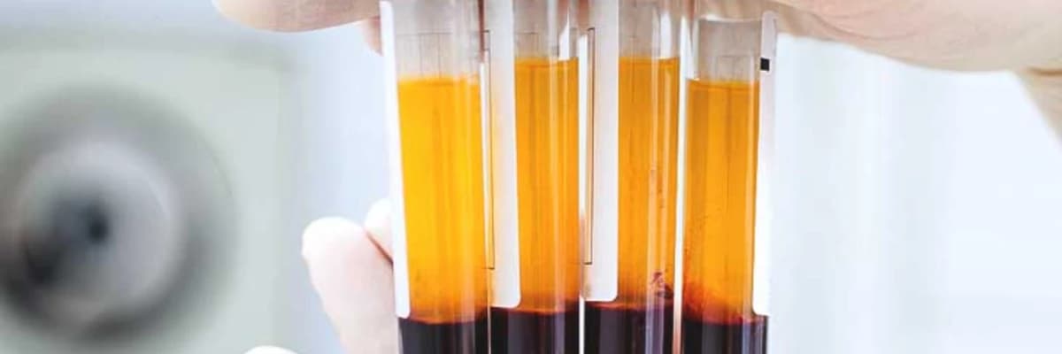 PRP (Platelet Rich Plasma - Trombositden Zəngin Plazma) nədir?