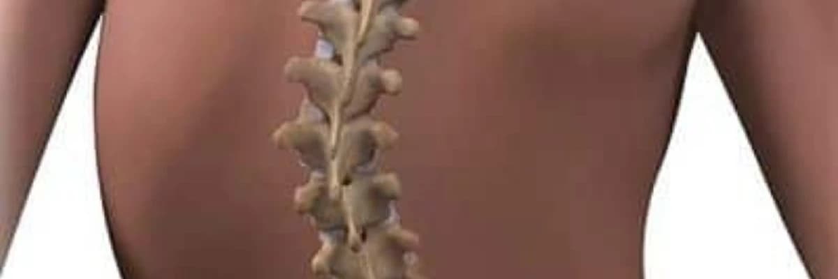 Skolioz nədir? Necə başa düşmək olar?