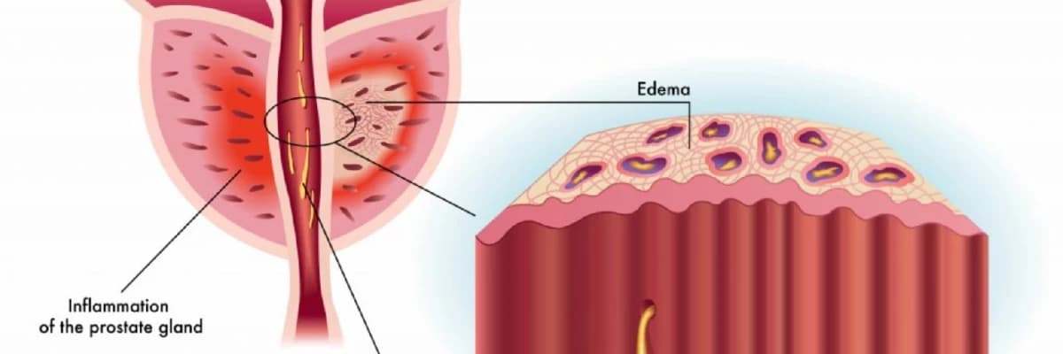 Prostatit: Prostat Vəzinin İltihabı