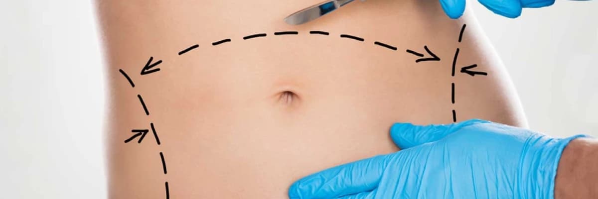 Qarın Germe Əməliyyatı: Abdominoplastika
