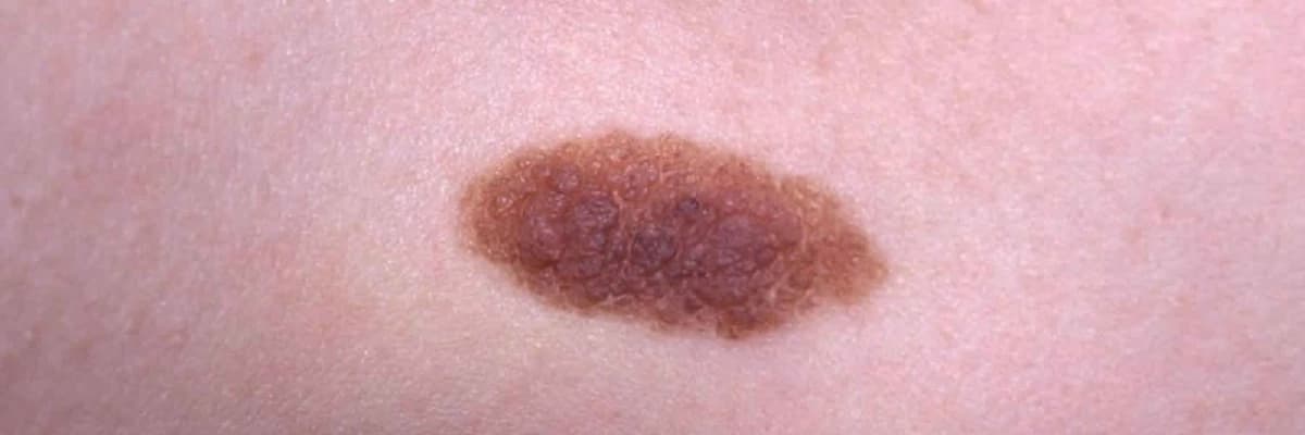 Nevus (Xal)