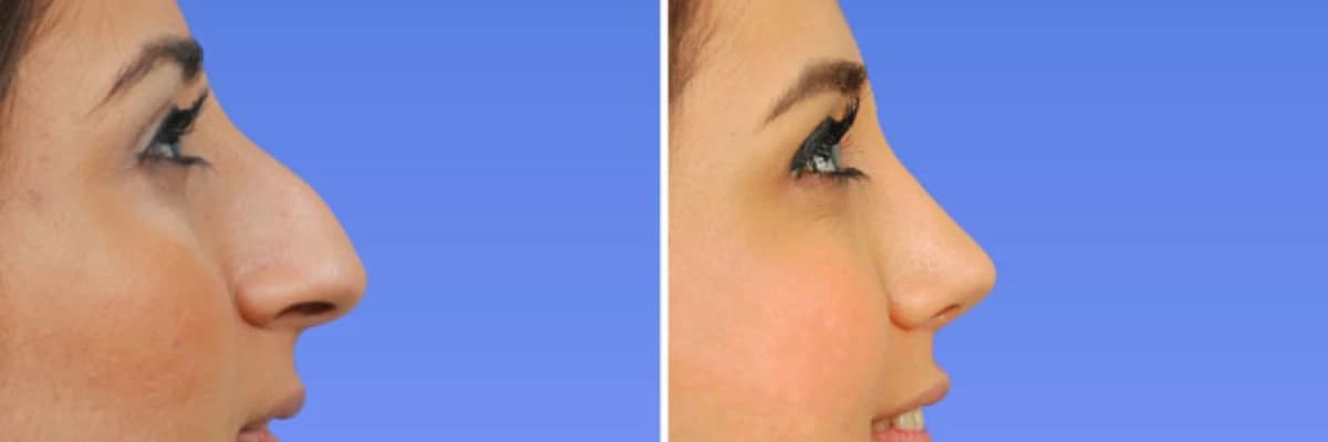 Estetik burun əməliyyatı