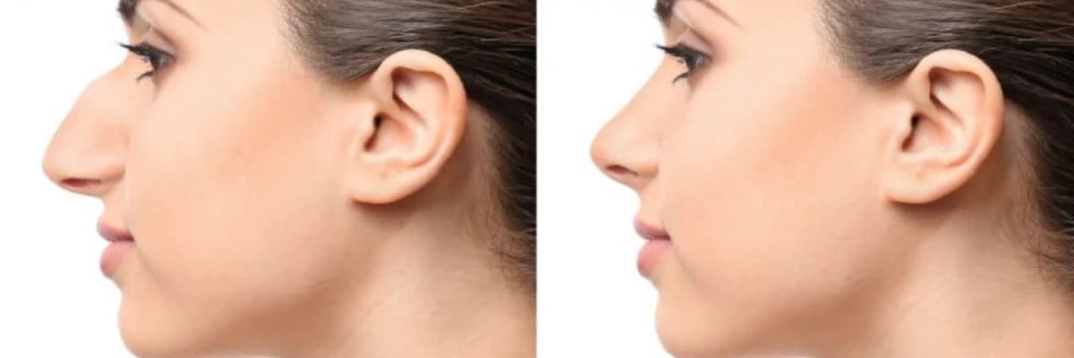 Burun Estetikası (Rinoplastika)