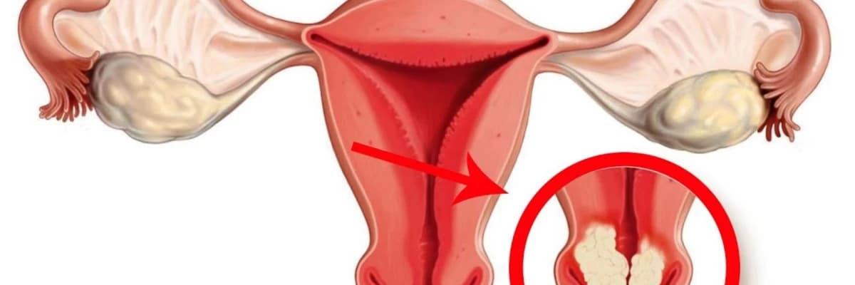 Rahim Ağzı Kanseri Ile Ilgili Bilmeniz Gereken 8 Gerçek!