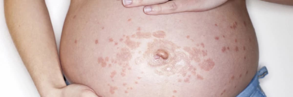 Hamiləlik Pemfikoidi: Hamiləlik zamanı görülən bir dəri xəstəliyi