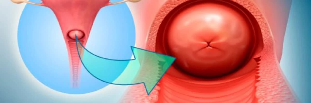 Uşaqlıq boynun ektopiyası/eroziyaları