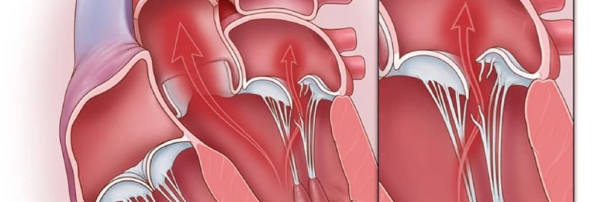 Mitral qapaq qusuru